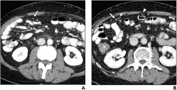 Positive Oral CT Contrast Improves Detection of Malignant Deposits